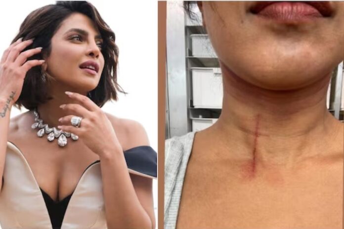 Priyanka Chopra Shares Injury Glimpse from 'The Bluff' Set