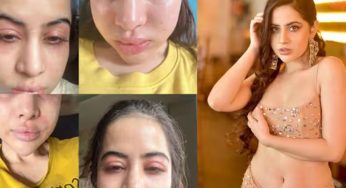 Uorfi Javed’s Swollen Face Worries Fans