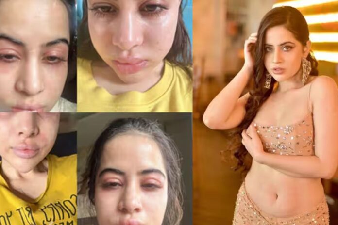 Uorfi Javed's Swollen Face Worries Fans