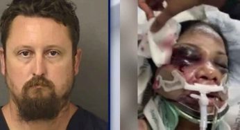 Indian-Origin Nurse Brutally Attacked in US Hospital; Assailant Says ‘Indians Are Bad’, ‘I Beat The F#**…’