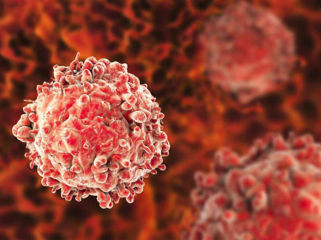 Acute Myeloid Leukemia: From Fatigue To Fever, The Subtle Symptoms To Know