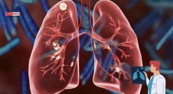 One in Three Young Adults in Delhi Show Early Signs of Lung Damage, CT Scan Data Reveals