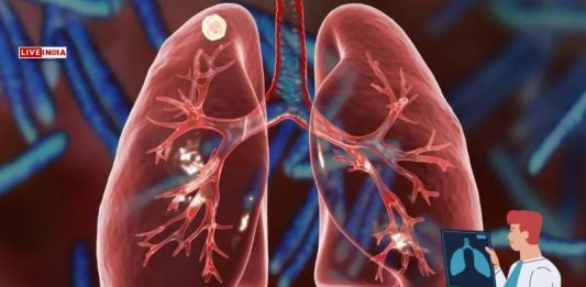 One in Three Young Adults in Delhi Show Early Signs of Lung Damage, CT Scan Data Reveals