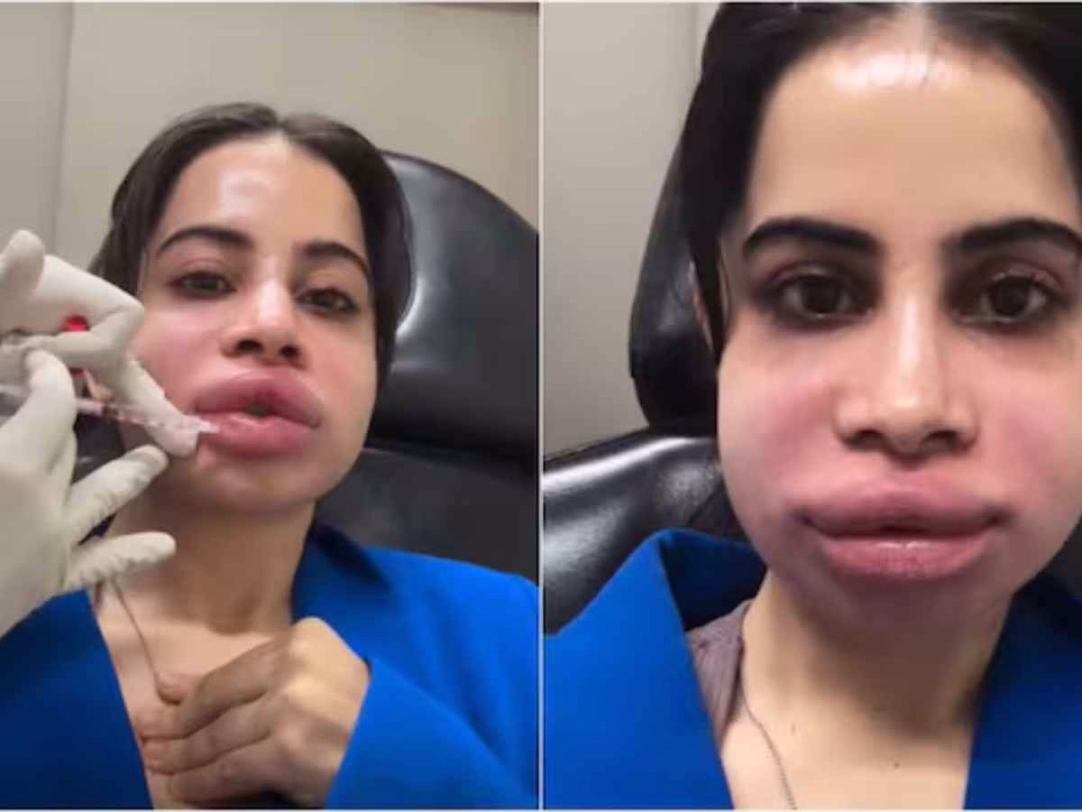 Uorfi Javed Shares Raw Video of Lip Filler Removal