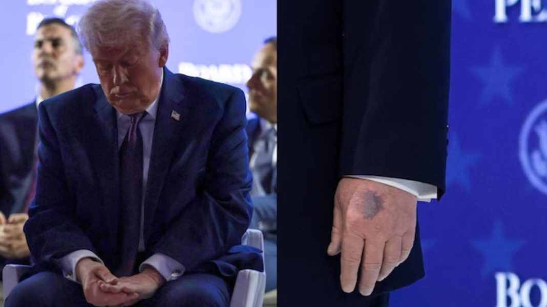 Trump Explains Bruise Seen at Davos
