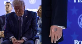 Trump Explains Bruise Seen at Davos
