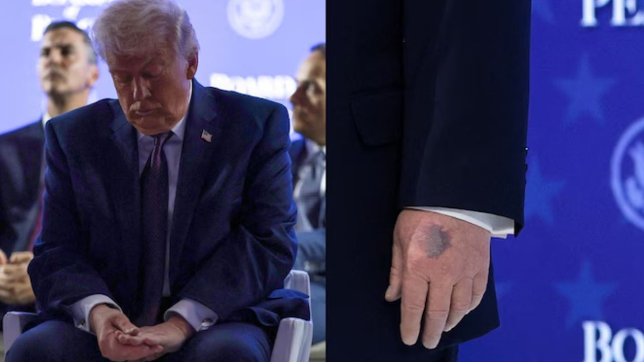 Trump Explains Bruise Seen at Davos
