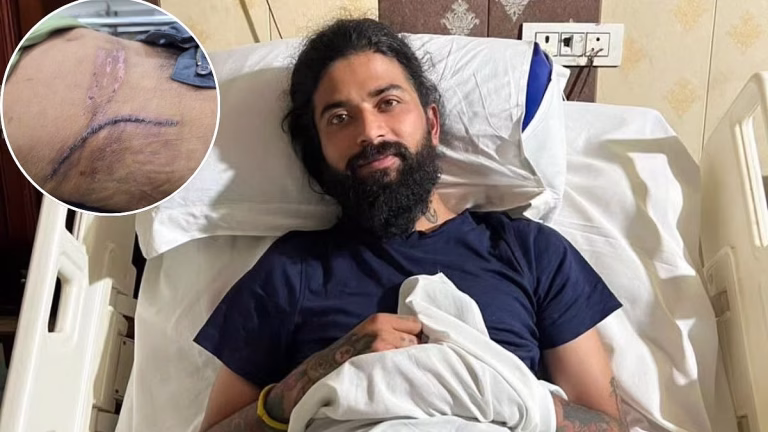 Anurag Dobhal AKA UK07 Rider Shows Injury Scars