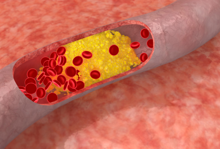 Beyond Cholesterol: Why the ApoB Blood Test is the New Heart Health Warning