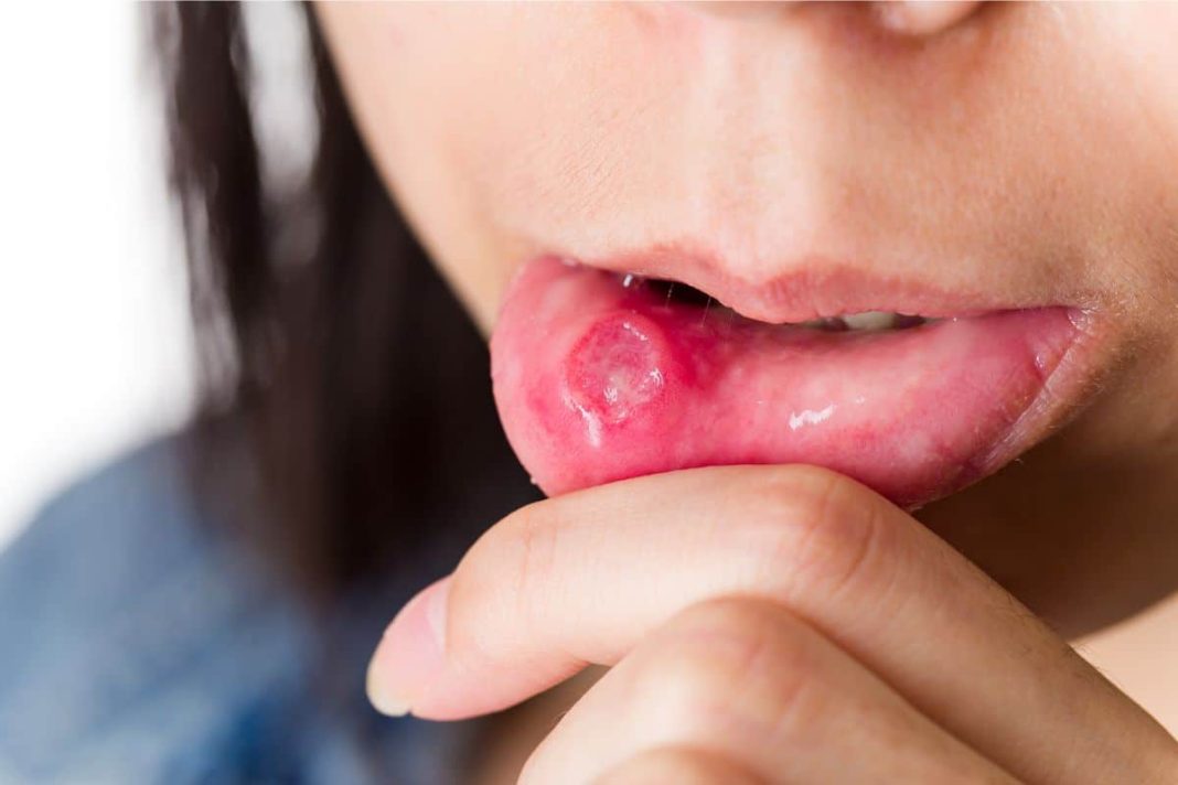 Want Quick Relief From Mouth Ulcers? Try These Easy Home Remedies