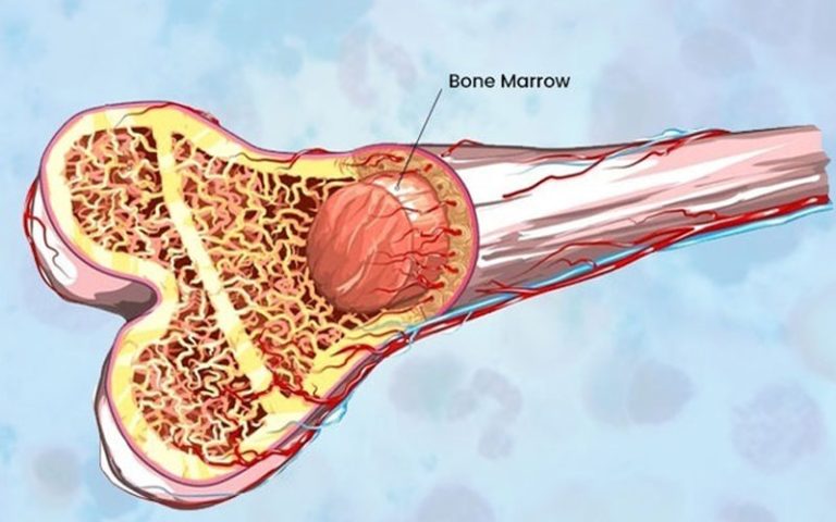 Bone Marrow Transplant Offers New Hope For Thalassemia Patients