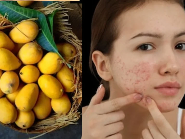 Do Mangoes Really Cause Acne? Experts Say Pairing Them With These 2 Foods Can Help Prevent Breakouts