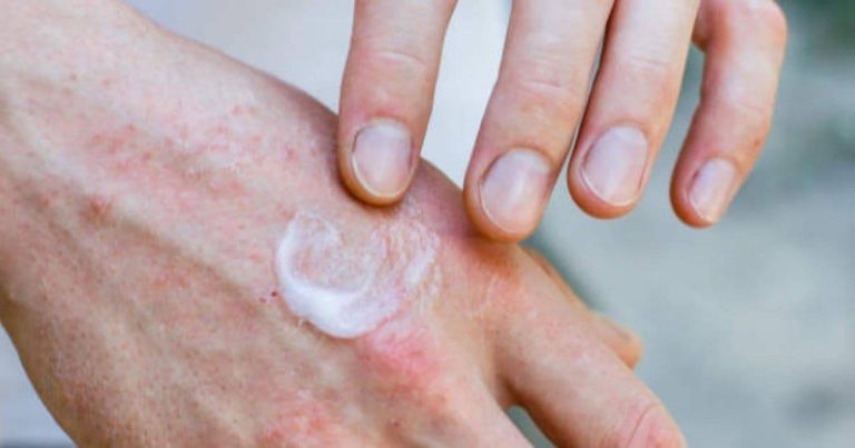 From itching to rashes: Understanding the early signs of eczema in summer