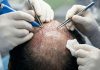 LeT Operative Sent To Kashmir Allegedly Got Hair Transplant In Srinagar LeT Operative Sent To Kashmir Allegedly Got Hair Transplant In Srinagar