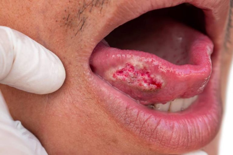 Oral Cancer Crisis in India: Why Cases Keep Rising Despite Awareness Campaigns