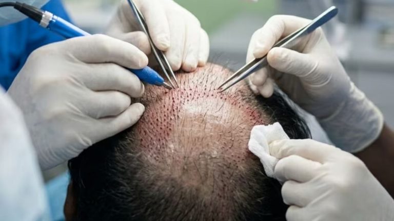 LeT Operative Sent To Kashmir Allegedly Got Hair Transplant In Srinagar