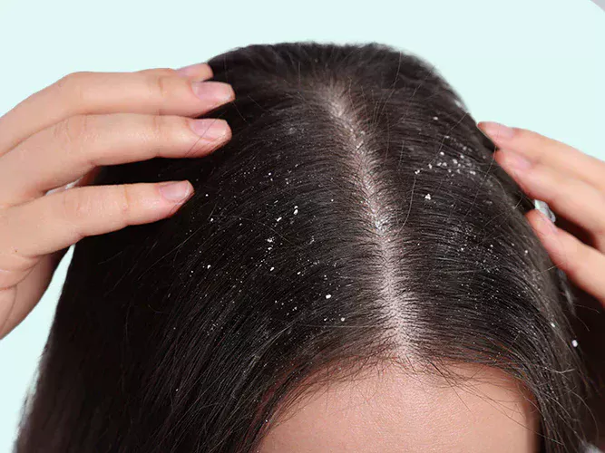 Oily vs Dry Dandruff: Dermatologists Explain Key Differences And Care Tips