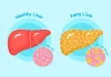 Global Fatty Liver Day 2026: 3 Simple Lifestyle Changes That Can Help Reverse Fatty Liver Disease Global Fatty Liver Day 2026: 3 Simple Lifestyle Changes That Can Help Reverse Fatty Liver Disease
