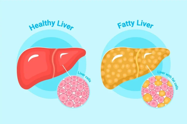 Global Fatty Liver Day 2026: 3 Simple Lifestyle Changes That Can Help Reverse Fatty Liver Disease