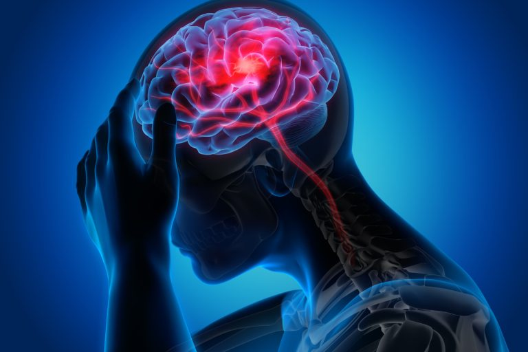 No Visible Symptoms: How A Silent Heart Tumour Triggered A Brain Stroke In A Teenager