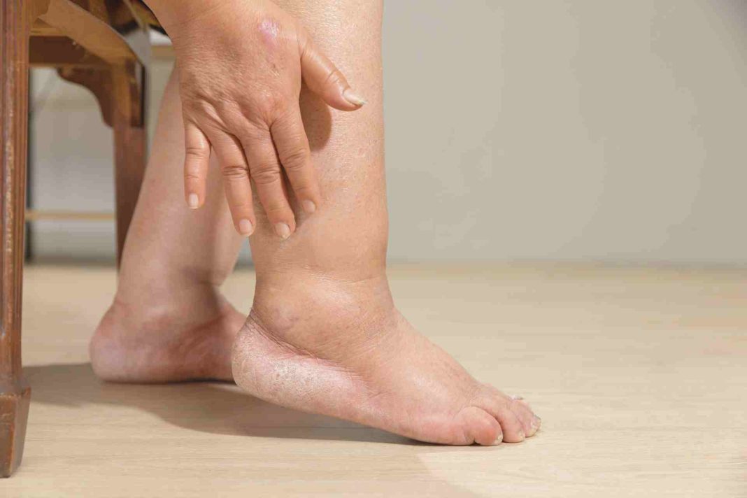 Summer Swelling Explained: Why Your Hands And Feet Puff Up In Hot Weather And How To Reduce It