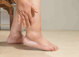 Summer Swelling Explained: Why Your Hands And Feet Puff Up In Hot Weather And How To Reduce It Summer Swelling Explained: Why Your Hands And Feet Puff Up In Hot Weather And How To Reduce It