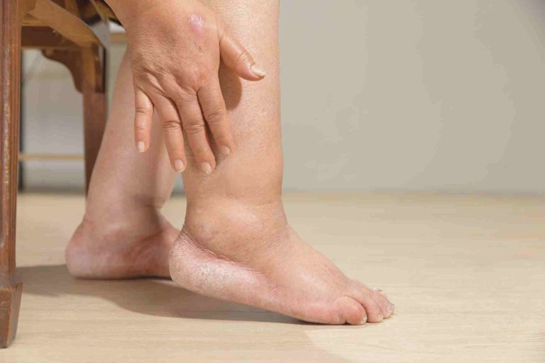 Summer Swelling Explained: Why Your Hands And Feet Puff Up In Hot Weather And How To Reduce It