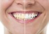 Want Whiter Teeth Naturally? These Simple Home Remedies May Help Reduce Yellow Stains Want Whiter Teeth Naturally? These Simple Home Remedies May Help Reduce Yellow Stains