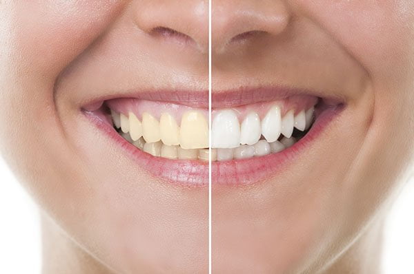 Want Whiter Teeth Naturally? These Simple Home Remedies May Help Reduce Yellow Stains