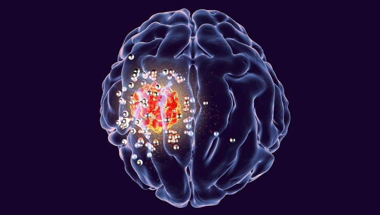 'Mind-Boggling': Longevity Startup Tests Brain Implant to Fight Glioblastoma