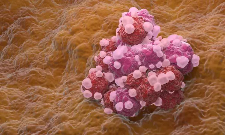 For decades, women diagnosed with platinum-resistant ovarian cancer have faced limited treatment options and poor survival outcomes. Now, a targeted therapy called mirvetuximab soravtansine is offering fresh hope to patients and oncologists alike.