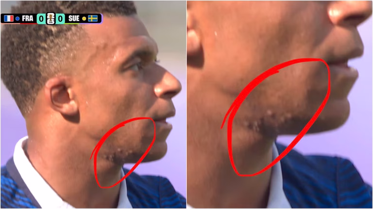 Kylian Mbappe's Face Marks Go Viral During FIFA World Cup 2026